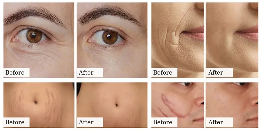 CO2 Laser Skin Resurfacing: applications