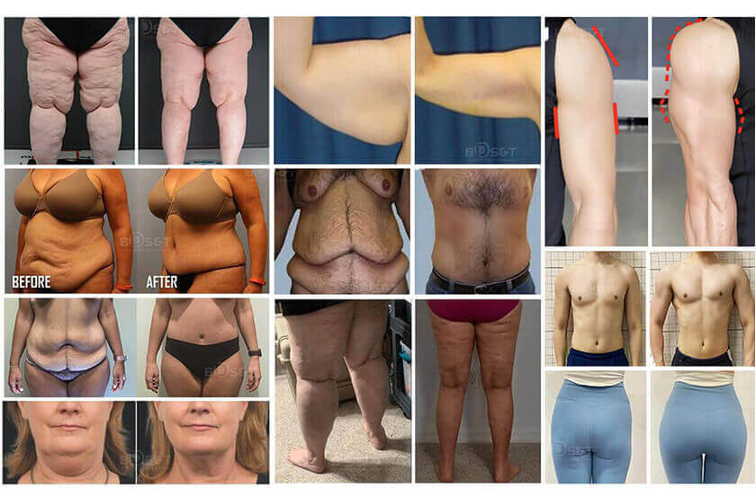 360 Cryolipolysis: applications