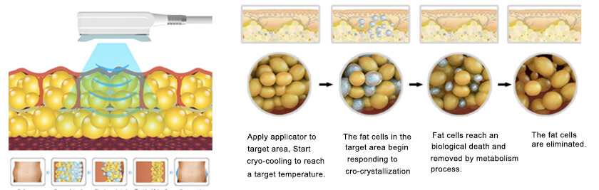 360 Cryolipolysis: equipment detail