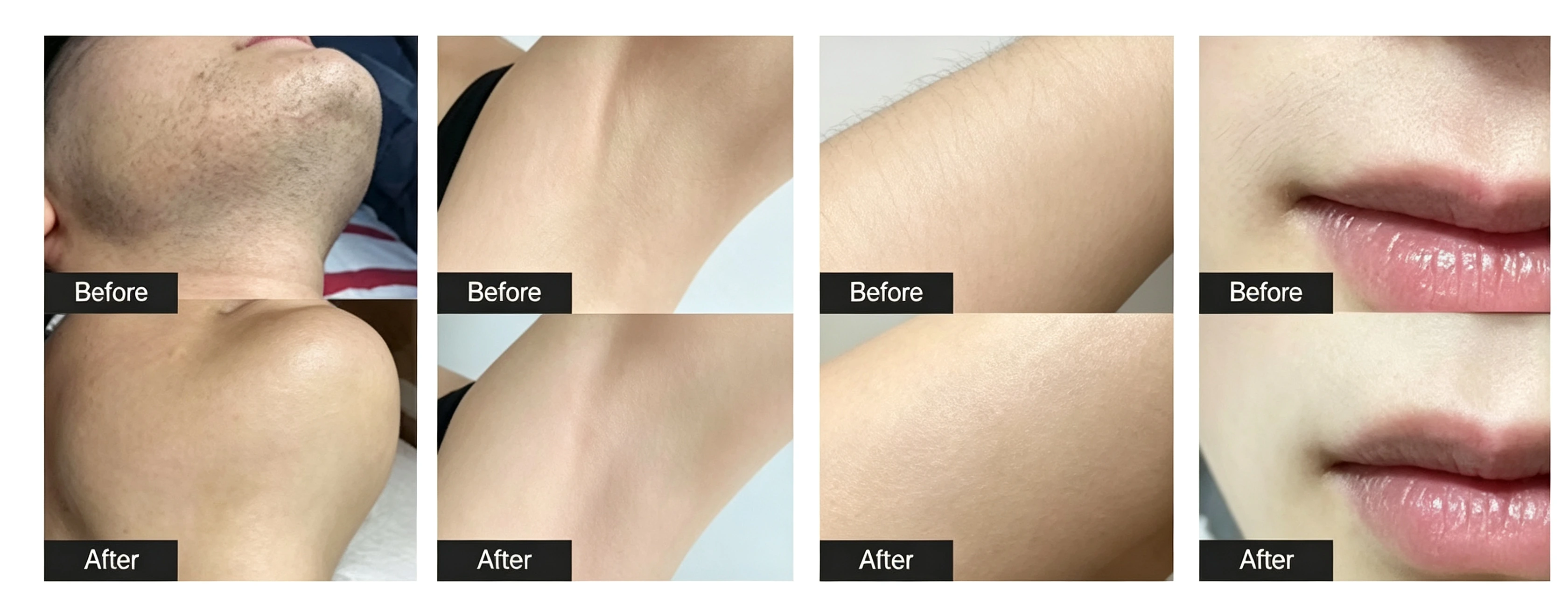 Diode laser hair removal: applications